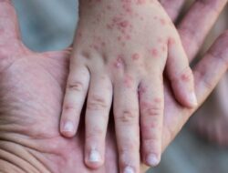 Kasus Campak Meningkat: Waspada Saat Liburan Lebaran